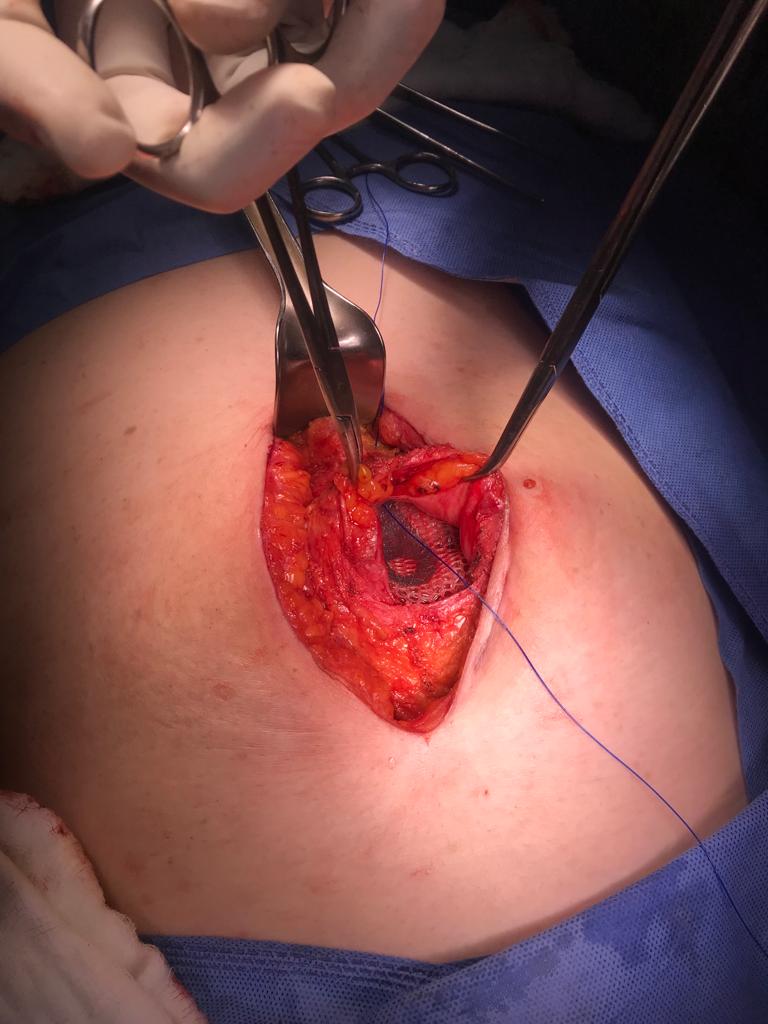 Colocacion de Malla en cavidad por Hernia Ventral