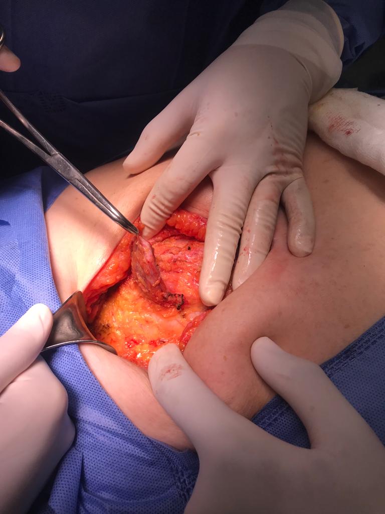 Saco herniario en hernia Umbilical